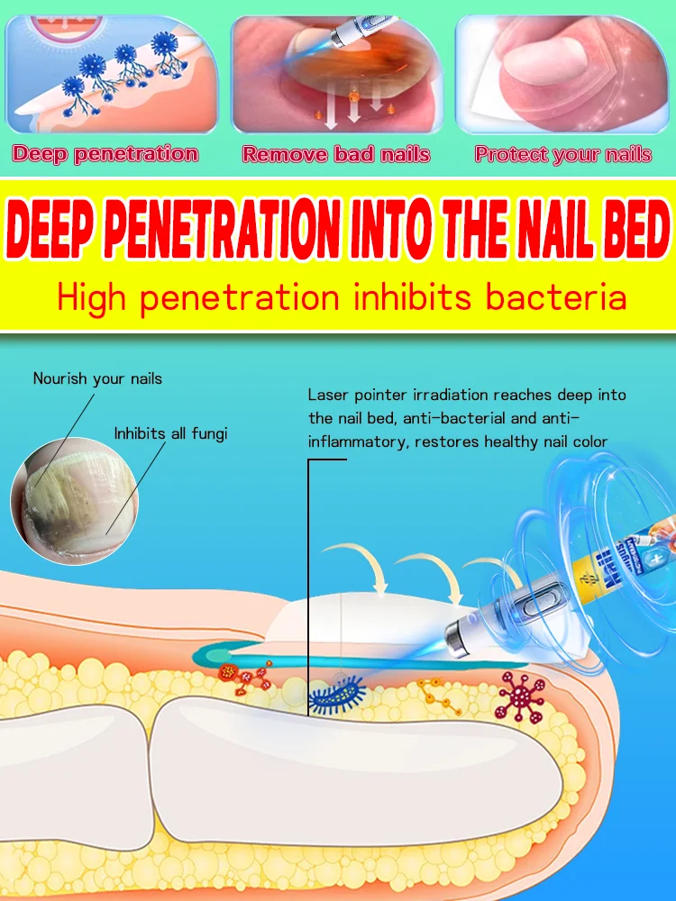 Easily solve nail fungus problems with laser treatment, the best solution for fungal nails.