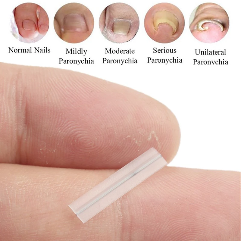 Ingegroeide teennagel Correctie Tool Rechttrekken Clip Brace Ingegroeide teen Nagelbehandeling Elastische patch Sticker Pedicure Tool