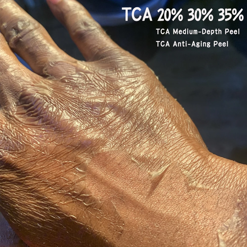 Crema refrescante con solución de neutralización para el cuidado posterior, resultados de la piel de la mano, quelnokova, TCA 20, 30, 35