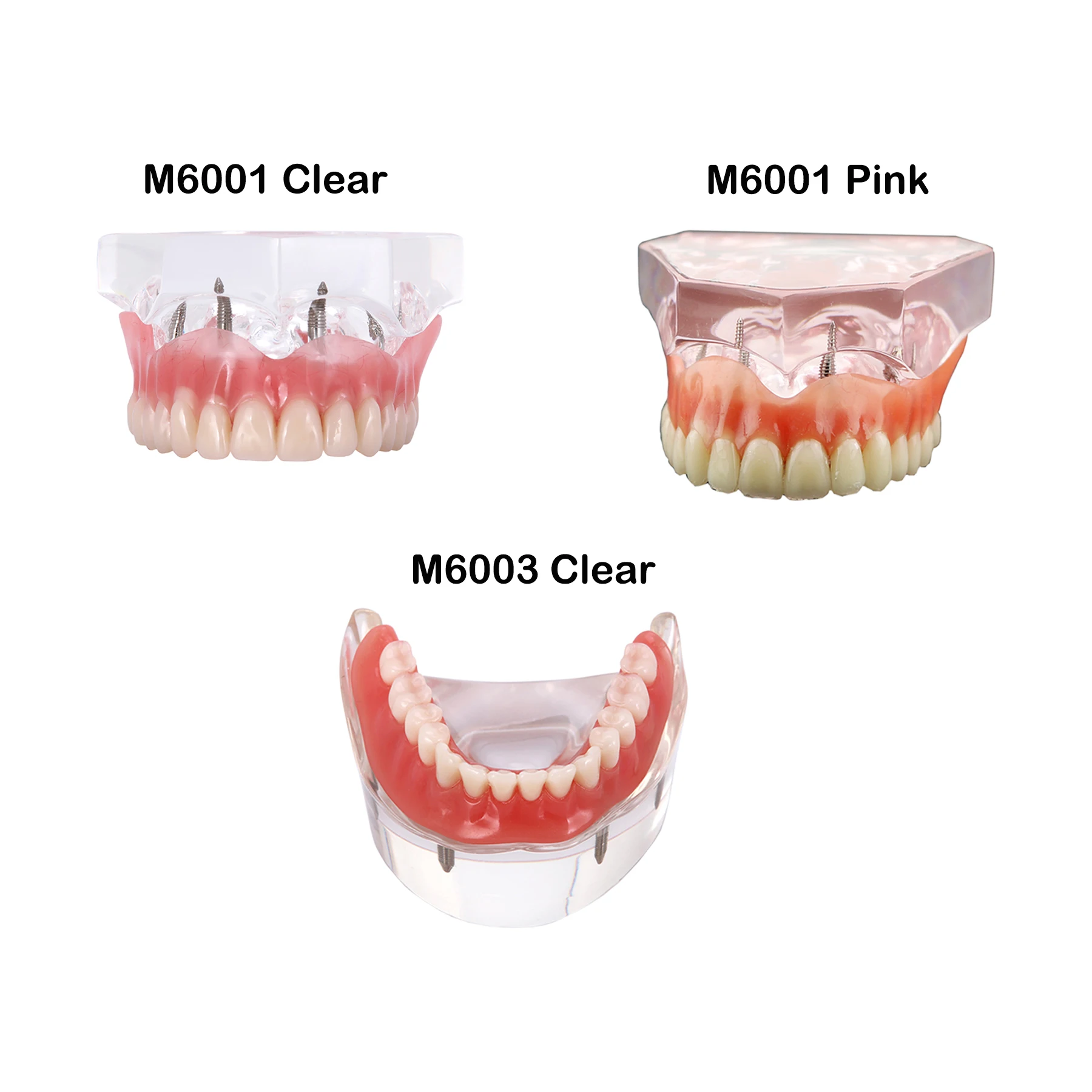 Dental Implant Teeth Model With 4 Implants Overdenture Restoration Model Removable For Dentist Patient Communication Demo