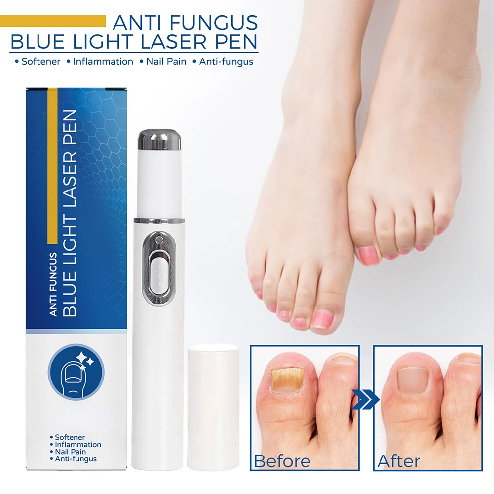 1Pcs Nail Fungus Treatment Pen Anti-fungal Repair Pen Blue Light Laser Pen Paronychia Nail Onychomycosis Painless Removal Care