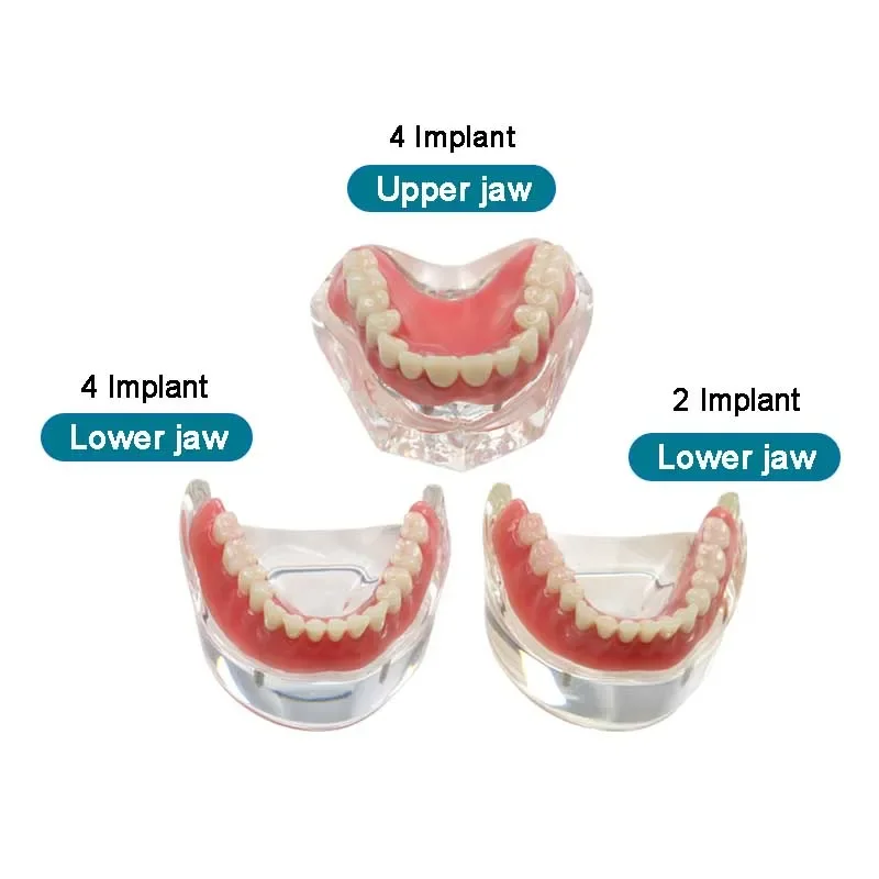 

Dental Teeth Model with Implant Overdenture Restoration Teeth Model Dentist Communication Model