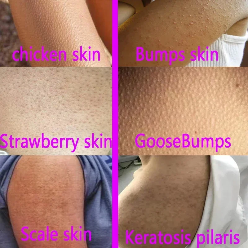 Keratosis Pilaris Cream For Strawberry Legs Removal KP Bump Eraser Body Scrub Remove Chicken Skin Improve Smooth Care Product