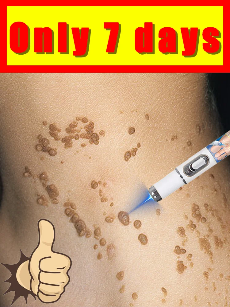 

Latest upgraded blue light pen solve warts,portable,free shipping,easy to use,wart care tools