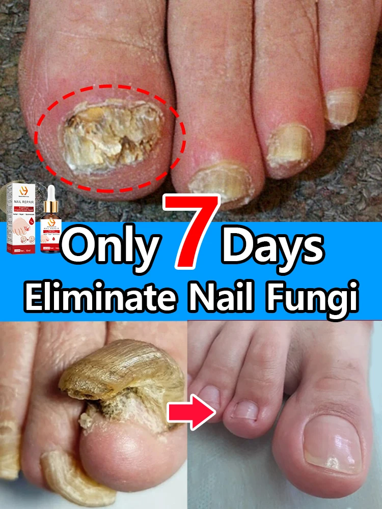 Eliminate nail fungi