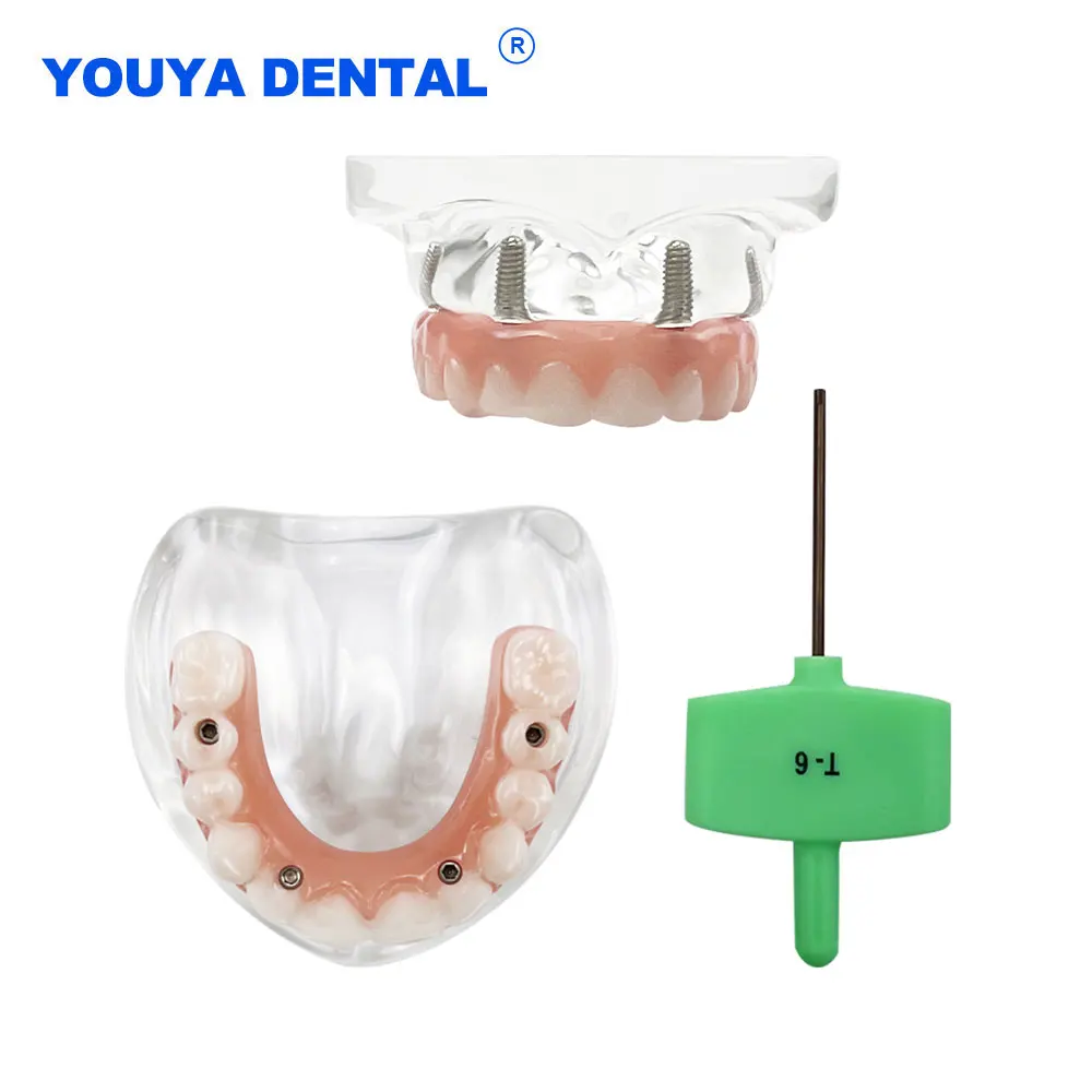 

4 Implants Dental Maxillary Teeth Implant Model With Implants Overdenture Demo Model For Student Dentist Learning Study Model