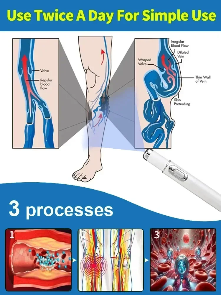 قلم ليزر أزرق مطور حديثًا، يحل الدوالي، مما يسمح لك أن تتمتع بأرجل صحية جديدة 2020 #6