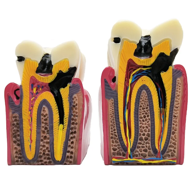 8 Times Dental Caries Model Disease Teeth Dental Model for Dental Demonstration Model Dentist Teaching Dental Lab Oral Research