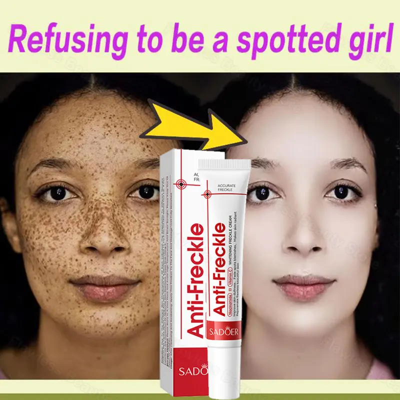 

Niacinamide Anti Freckle Whitening Cream Dark Spot Remover Fade Melasma Melanin Pigmentation Brighten Skin Care Korean Cosmetics