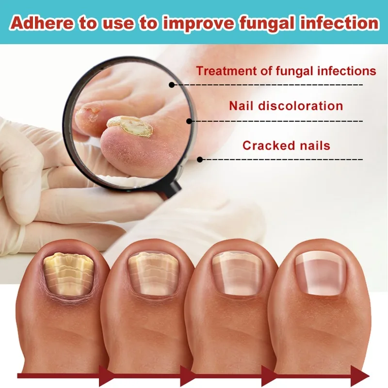 Parches de hongos para uñas encarnadas, Corrector de uñas encarnadas, tratamiento de paroniquia, herramientas portátiles de reparación para el cuidado de los pies