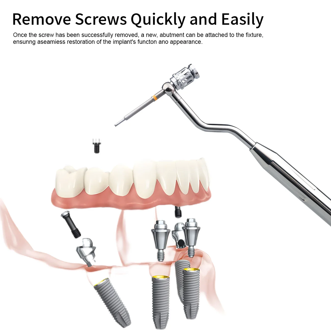 1 Set Dental Implant Removal Kit, Damaged Screw Extractor Set, Universal Implant Prosthetic Kits For Clinic