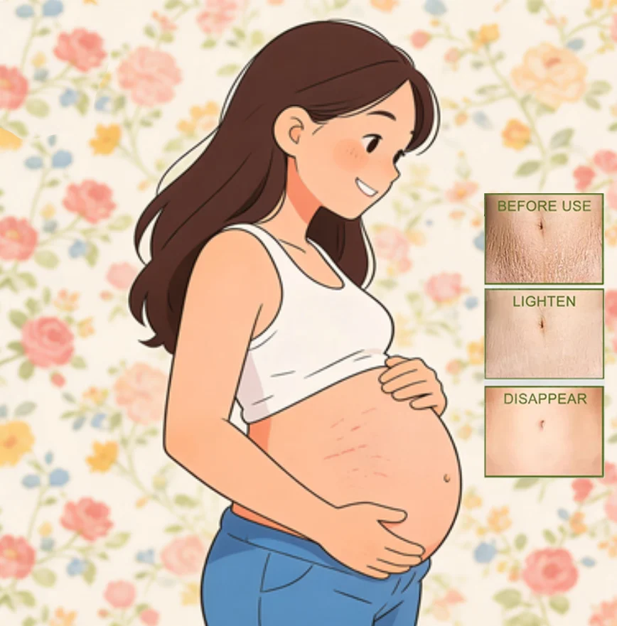 Stretch Mark Repair Cream Powerful Precious Body Scar Postpartum Stretch Marks Obesity Skin Care Remover