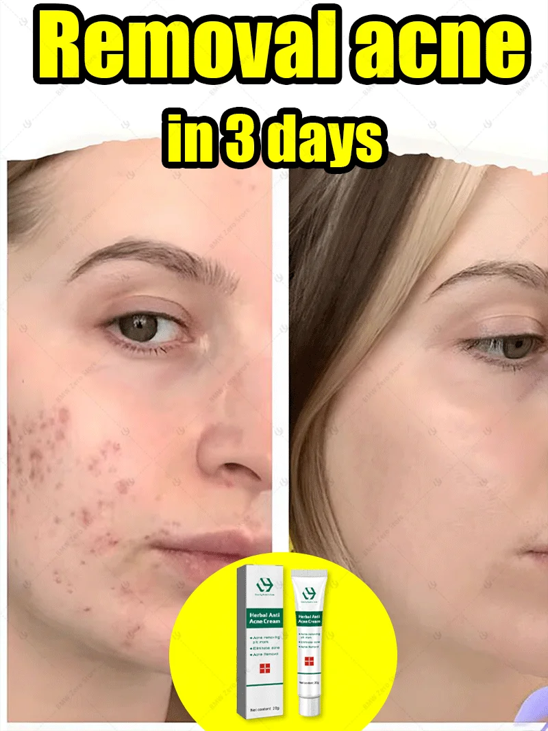 إصلاح ندبات حب الشباب للوجه واستعادة البشرة الصحية