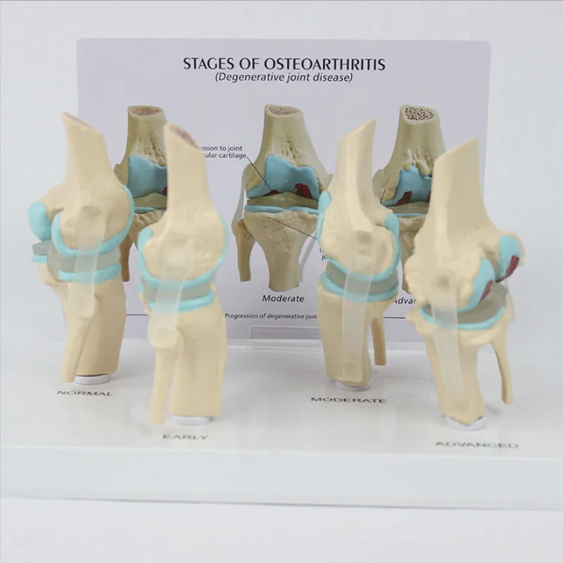 4-stage knee joint model Plastic Bone Model Pathological Knee Model Medical Teaching Model PVC Model