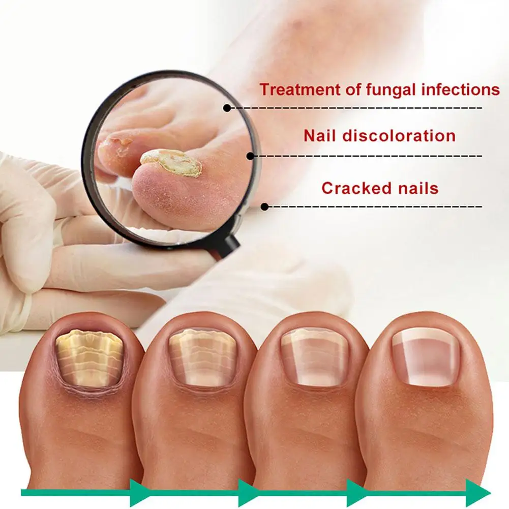Extra Strong Nail Fungus Treatment Serum Essence oil Repair Removal Fungal Feet Nails Care Toe Anti Infection Cream Essence O1T5 view 5