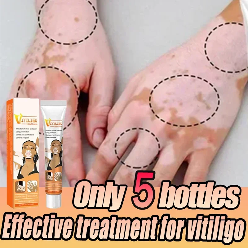 Vitiligo-Creme, natürliche Linderung, Hautbehandlung, beruhigende Entfernung weißer Flecken, Vitiligo-Creme, beseitigt Pigmente