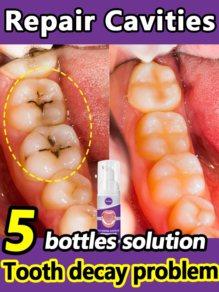 

Anti Caries Tooth Decay Repair Decay Cavities