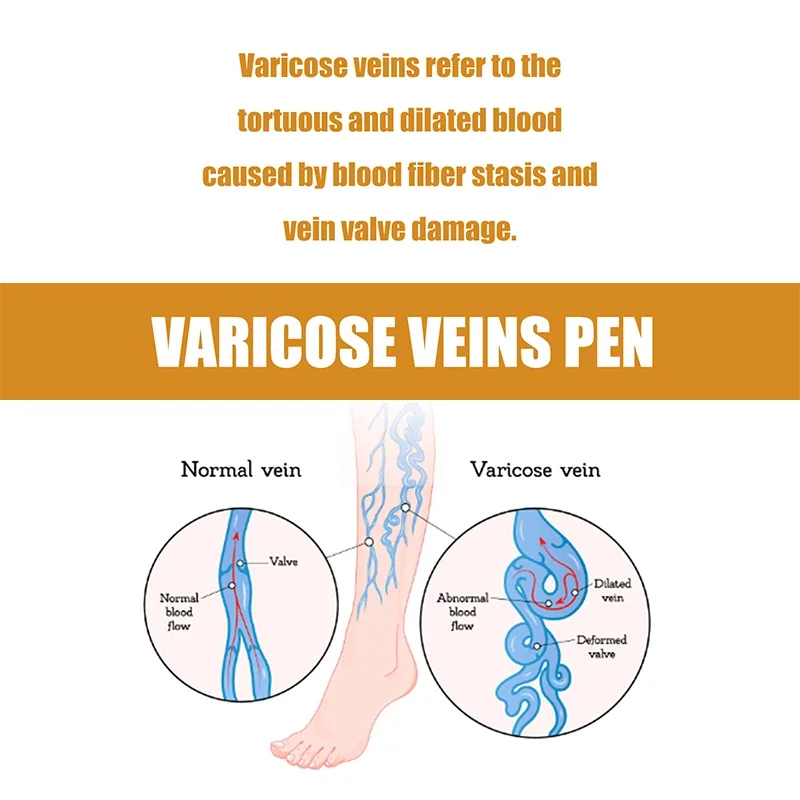 3Pcs Varicose Veins Laser Therapy Pen Improves Varicose Vein Cream For Men And Women Relieve Leg Pain Improve Blood Circulation