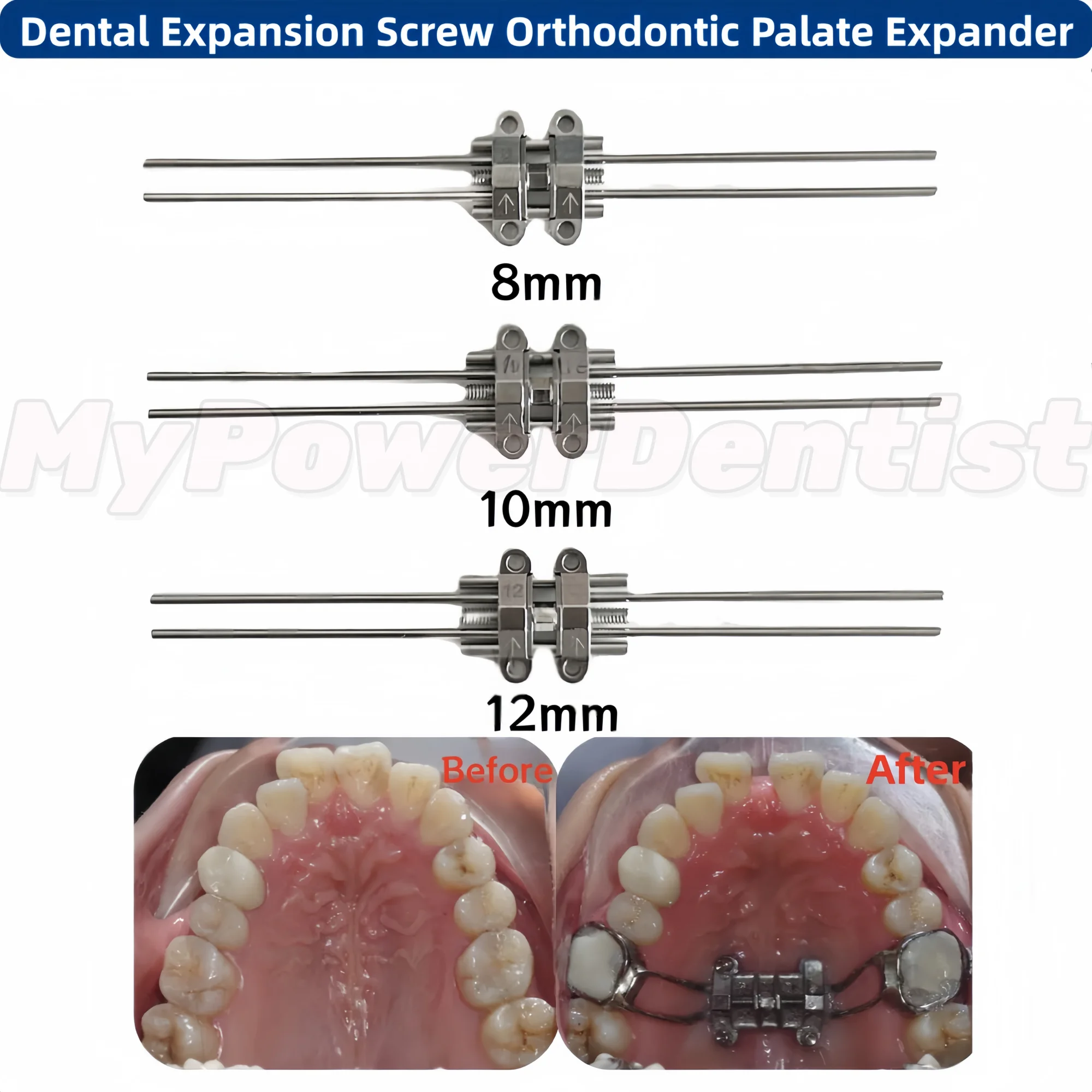 

Dental Expansion Screw Orthodontic Palate Expander Frame Type 8/10/12mm Ortho Dentistry Tools