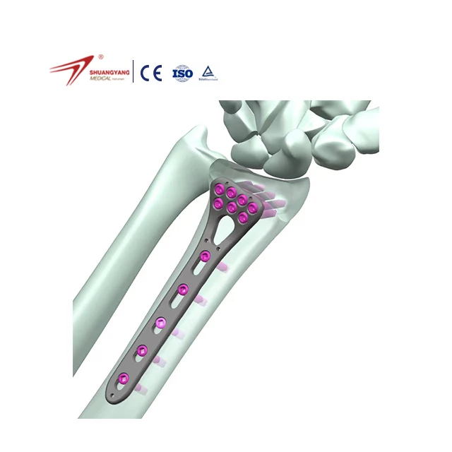 Medical Implants & Interventional Materials 3.0 Serie Multi-Axial Radius Locking Plate And Screw Distal Radius Locking Plate Set