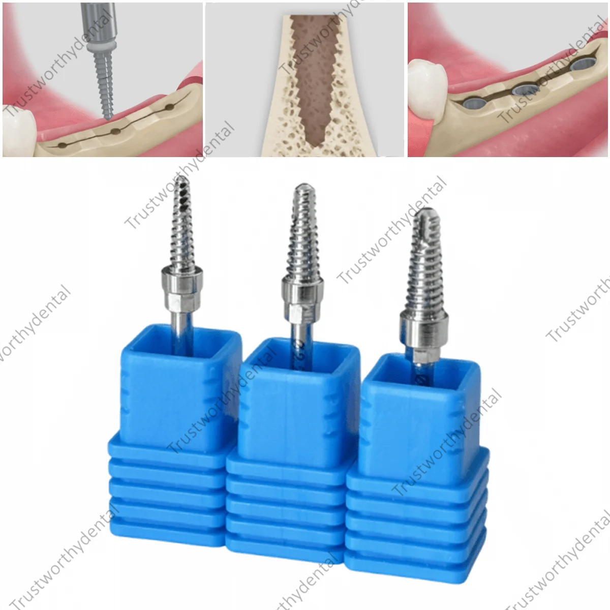 

3Sizes Dental Bone Expansion Drill Split Narrow Ridge Handpiece Compression Expander Widen Electric Drills GBR Fits Esset Kit