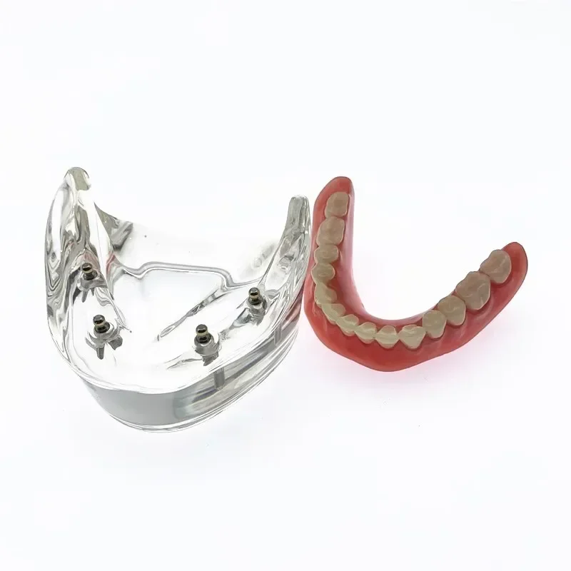 Dental Teeth Model With 4 Implant Overdenture Lower jaw Teeth Study teaching model