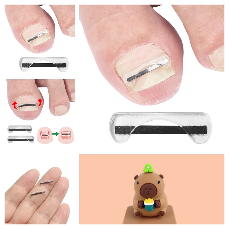 발톱 교정기 티타늄 합금 발톱 교정 와이어 자란 손톱 치료 장치 스티커 실리콘 도구 발 관리