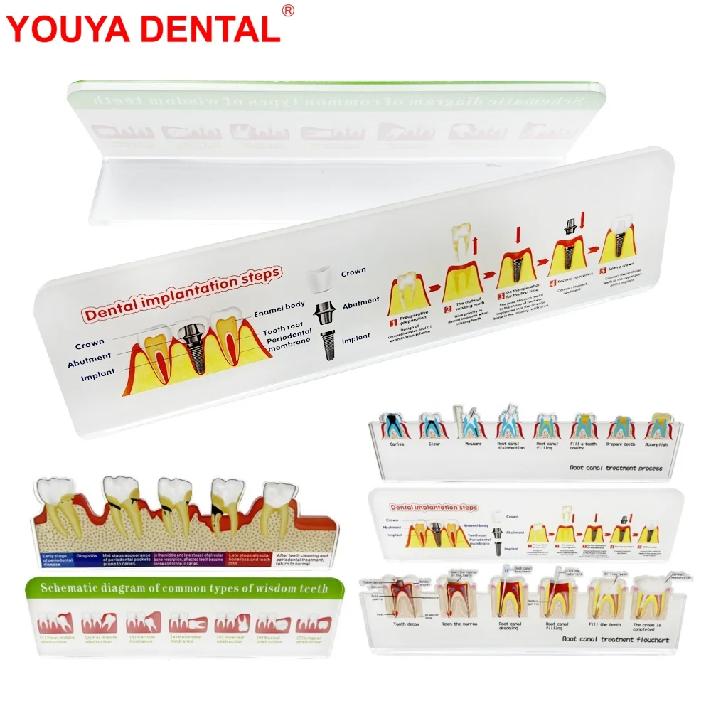 

Dental Implantation Steps Ornaments Root Canal Treatment Flowchart Wisdom Teeth Schematic Diagram Dentist Accessories Decoration