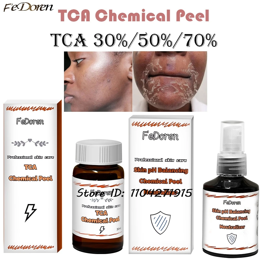 30 مللي حمض الجليكوليك TCA قشر كيميائي 70%/20% تقشير حمض الجلد إزالة الجلد Superforce تقشير العناية بالبشرة #1