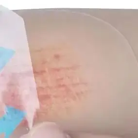 

2Pcs Ultra Thin Hydrocolloid Dressing Patches Wound Dressing Adhesive Breathable Waterproof Pad Help Wound Healing Skin Care