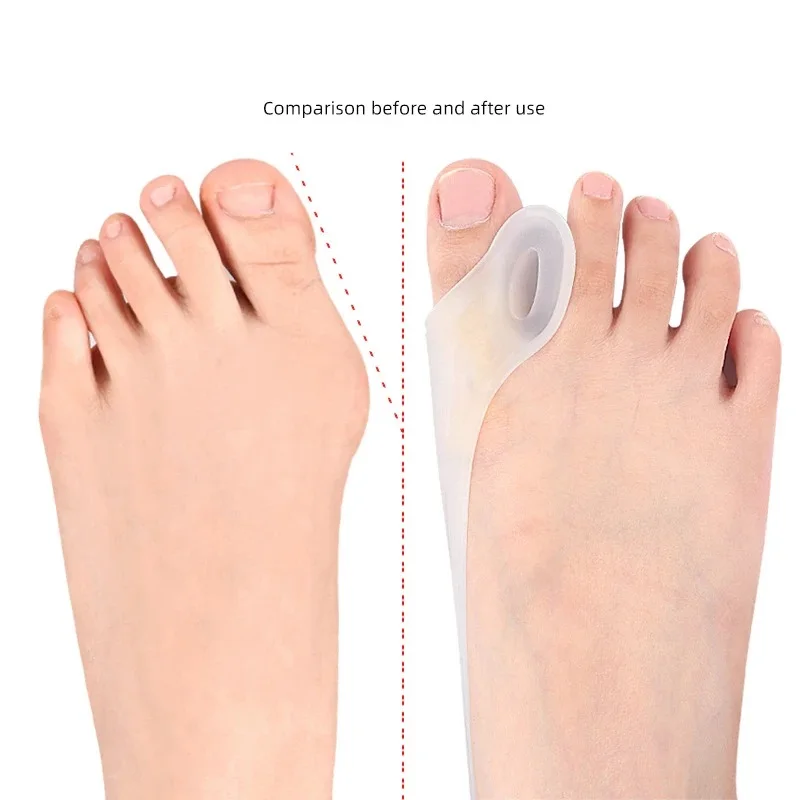 1pcs Siliconen Gel Duim Corrector Bunion Voet Teen Hallux Valgus Protector Separator Vinger Stijltang Richter Voetverzorging Tool