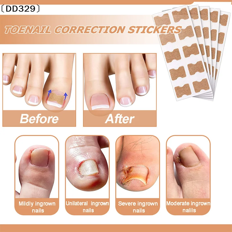 maveraDD329 Lapiza60Pcs Autocollants de Correction des Ongles Incarnés Patchs Correcteur d'ongle Patchs Traitement Récupérer Correcteur Pédicure Outil de Soin des Ongles