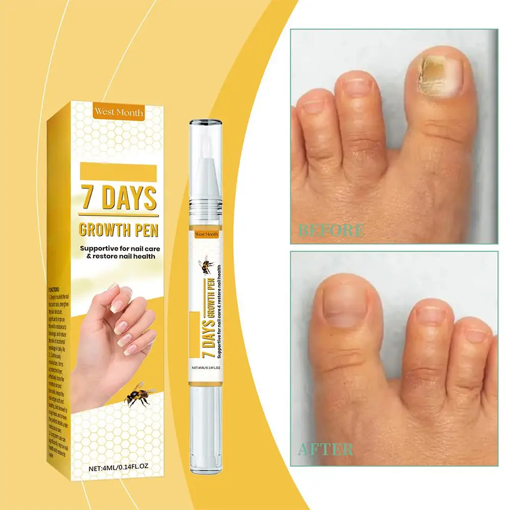 4ml Nail Repair Solution Applied To Nails For Care Of Hand Feet Nails Suit For Nail Damage Onychomycosis Nail Care Y8j5