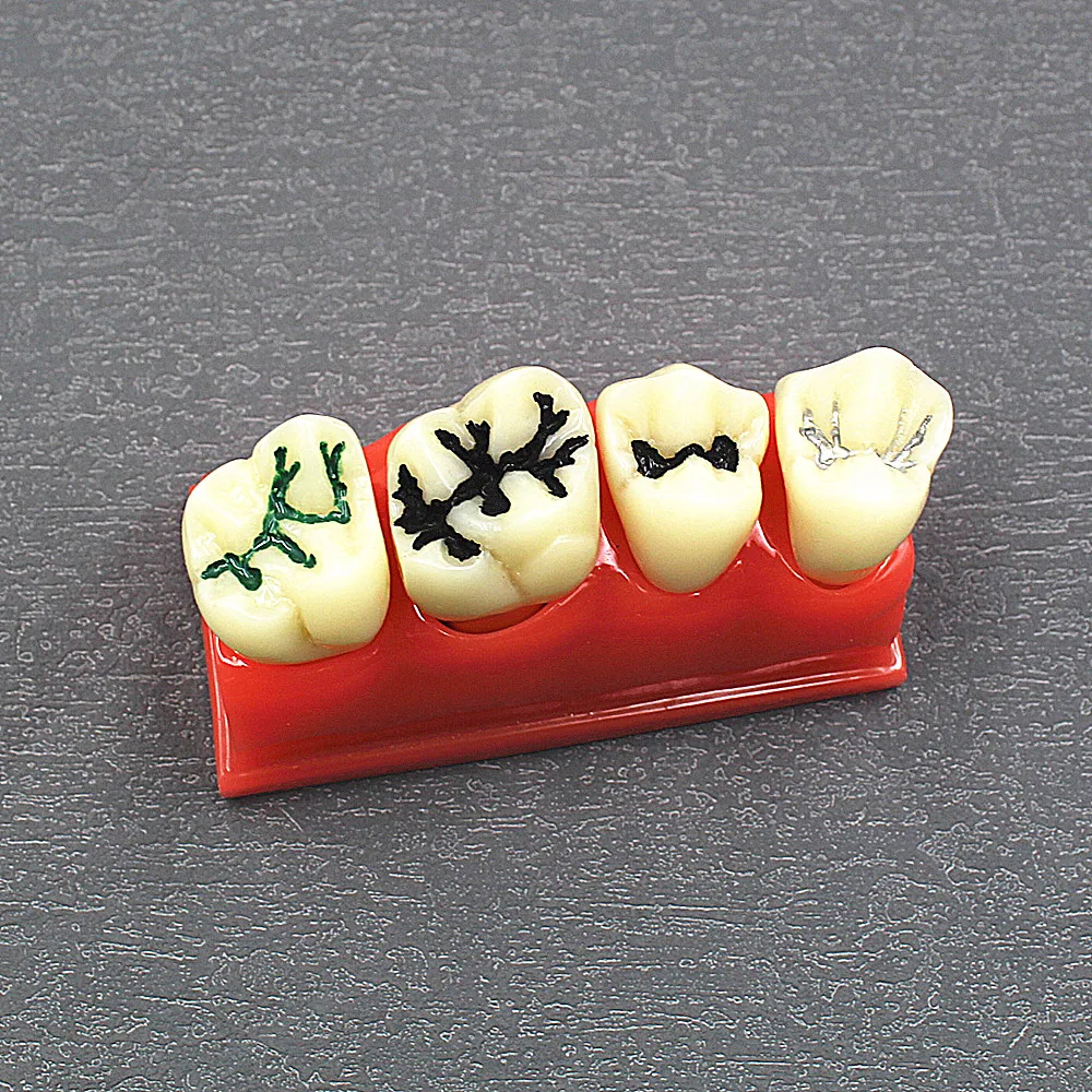 1 Pcs Dental Materials Lab Teeth Model Caries Comparative Study Models For Dentist Studying and Researching