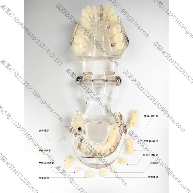Suitable for Teaching Model Detachable Teaching Ready Denture Model Ornament