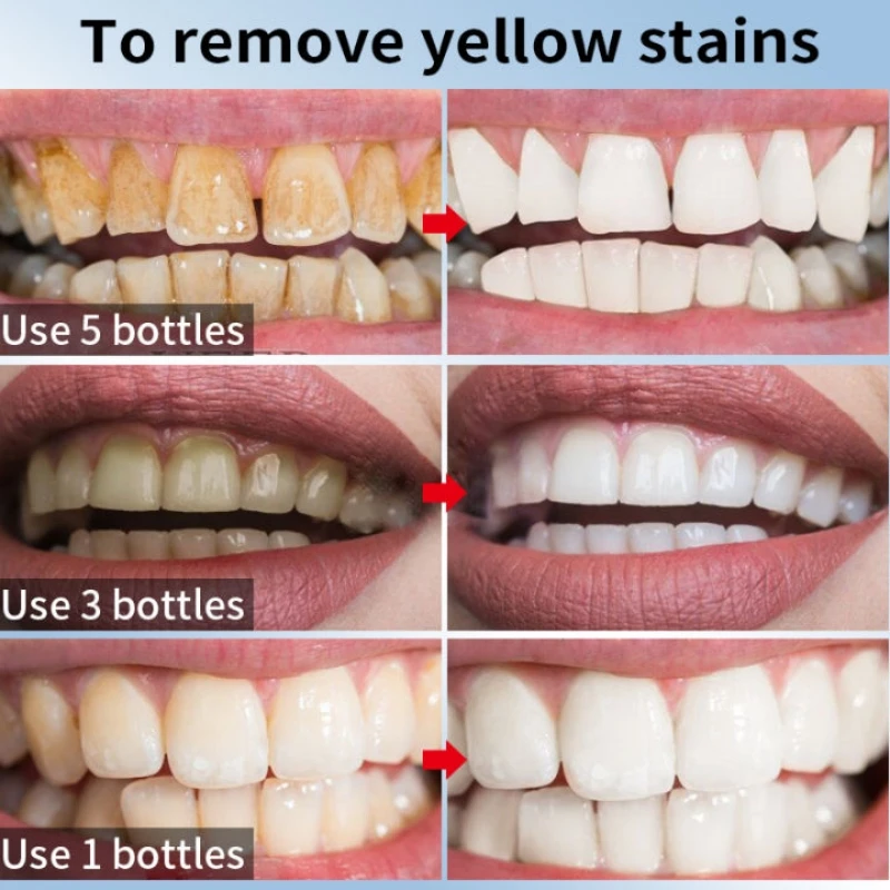 Dissolvant de calcul dentaire anti-mauvaise haleine, blanchiment des dents, dentifrice jaune, éclaircir, prévenir la parodontite, soins de nettoyage dentaire