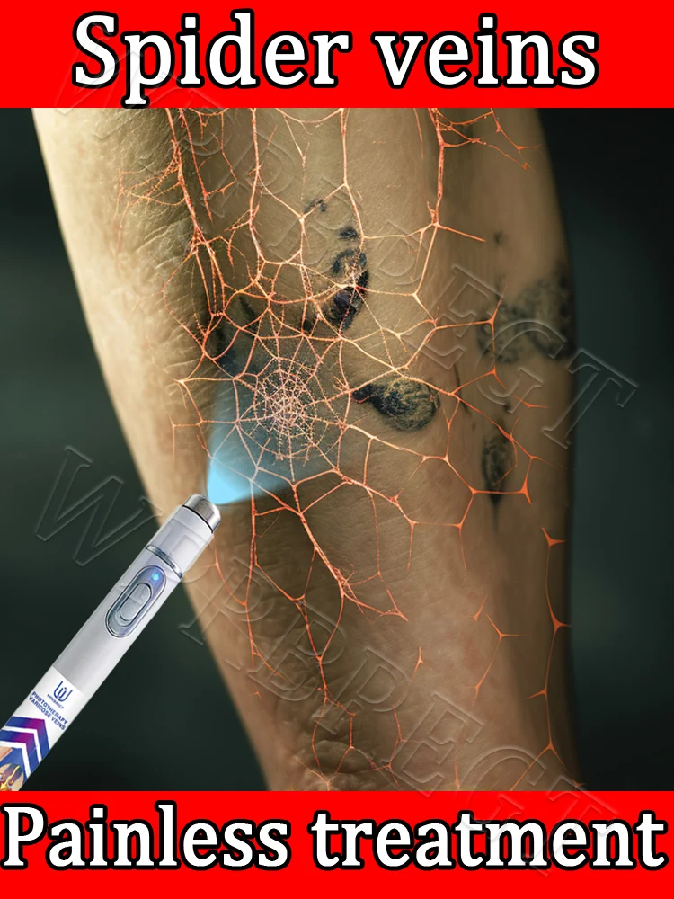 

Laser treatment for varicose veins