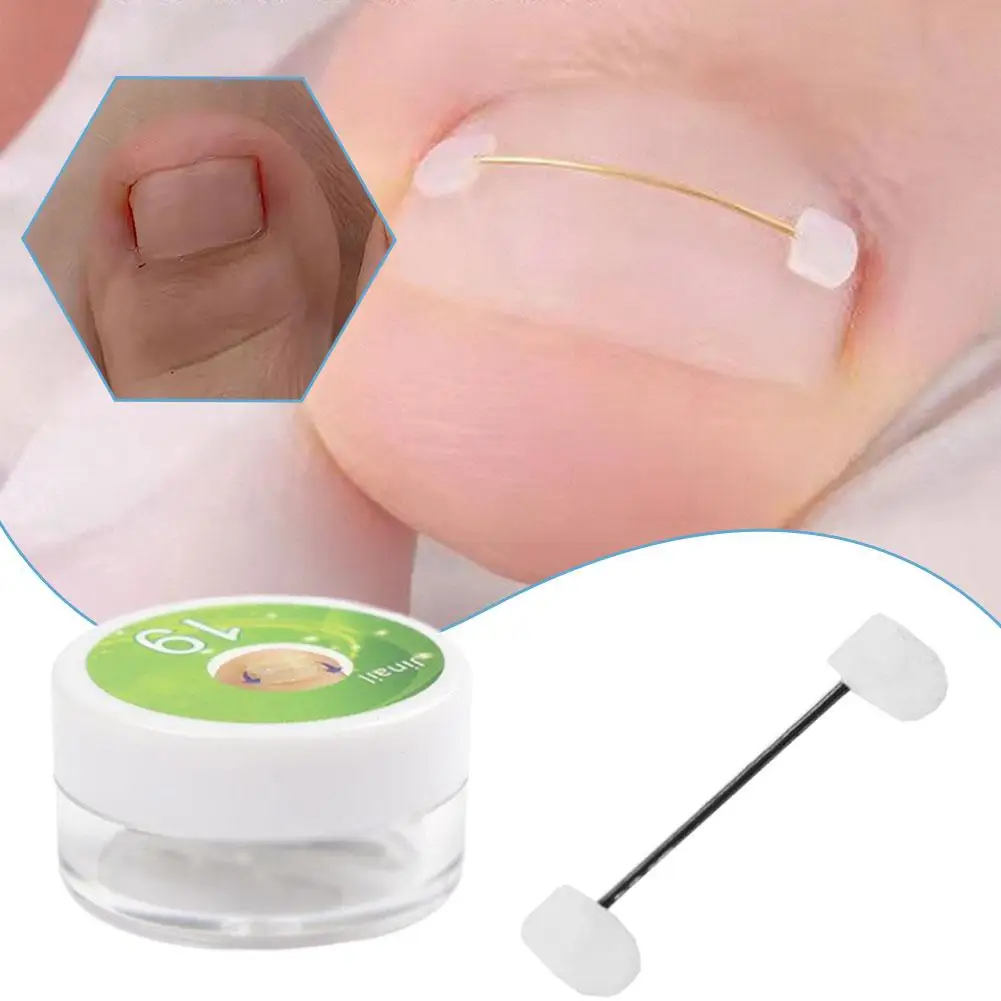 

Ingrown Nail Corrector Kit With Titanium Wire Sticker For Toenail Hallux Valgus Treatment Medical Care Solution
