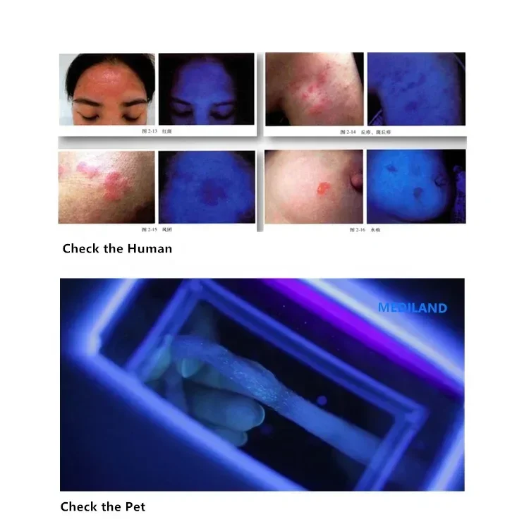 NEW Portable Woods Lamp ML-409 Medical Grade Microscope Dermatoscope With White LED Light Rechargeable Hair Analyzer CE