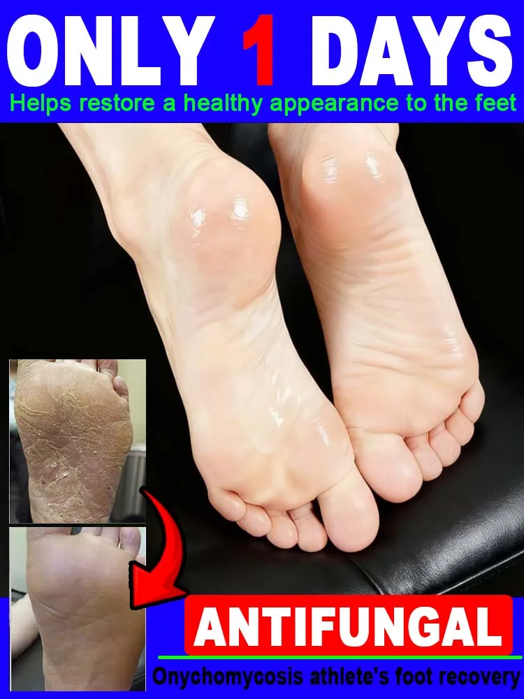 

Hᴇᴀʟɪɴɢ Fᴏᴏᴛ Uʟᴄᴇʀs, Tɪɴᴇᴀ Pᴇᴅɪs, Aɴᴅ Fᴜɴɢᴀʟ Iɴғᴇᴄᴛɪᴏɴs Oғ Tʜᴇ Fᴇᴇᴛ Natural care