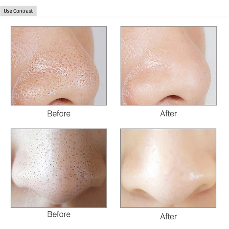 منظف المسام الكهربائي لإزالة الرؤوس السوداء من LESEN للوجه أو الأنف وبقع حب الشباب والبثور وإزالة الرؤوس السوداء والتنظيف العميق #1