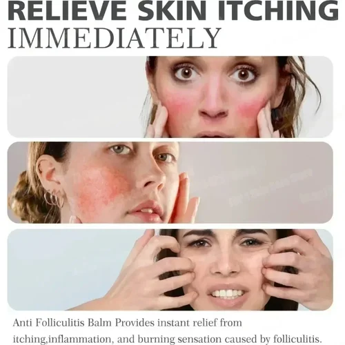 Imagen 2 del producto Crema antiacné que elimina eficazmente los nódulos de la piel, pústulas, cistos, papulos, puntos negros, hombres y mujeres, crema de esencia para el cuidado de la piel