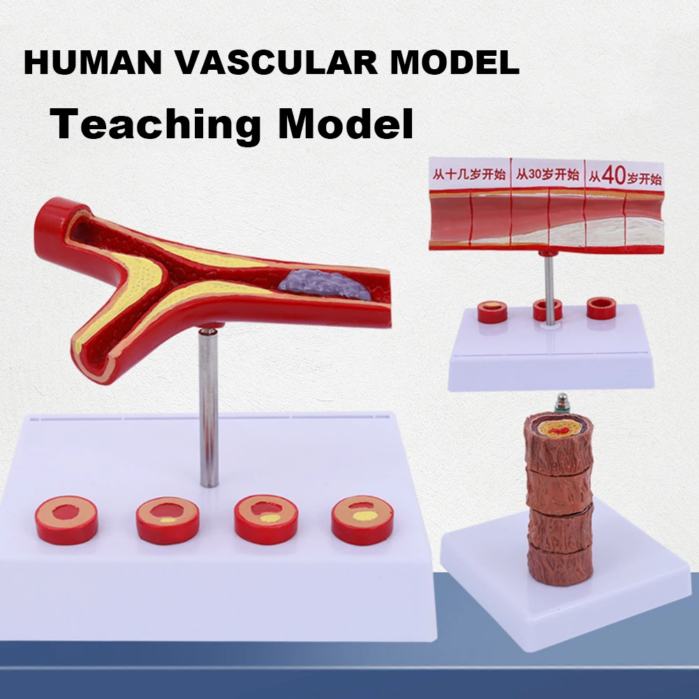 Modello di occlusione vascolare concentrazione nel sangue patologia del grasso del vaso sanguigno arteriance/modello di anatomia patologica vascolare