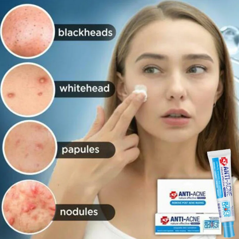 

Herbal Anti Effective Acne Removal Cream Traditional Chinese Medicine Treatment Shrink Pores Spots Gel Whitening