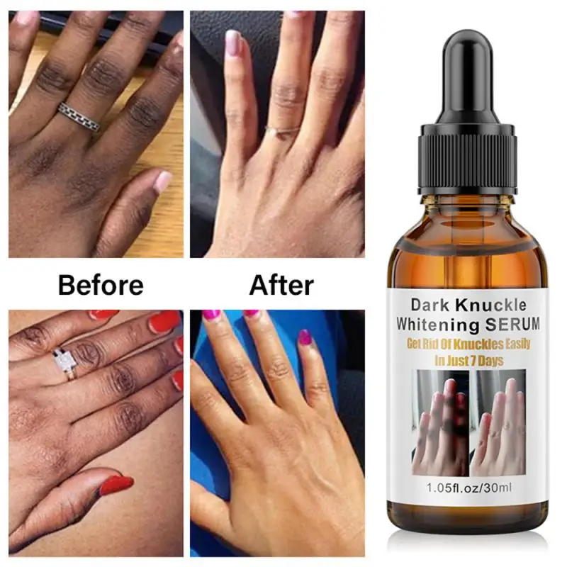 Dark Knuckles Soro de clareamento rápido, pigmentação correctores para pele negra, mão, cotovelos, joelho, removedor de manchas intensas