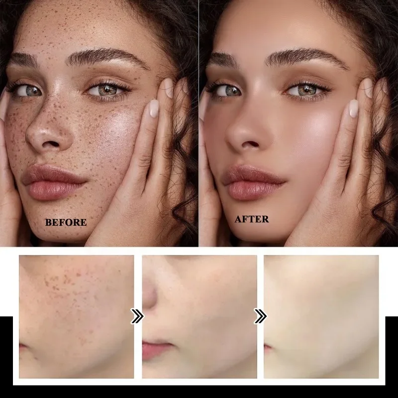 Melasma Remover Cream usuwanie ciemnego pigmentu rozjaśniający krem do twarzy znikną melaninę krem nikotynamid rozjaśniający emulsja nawilżająca