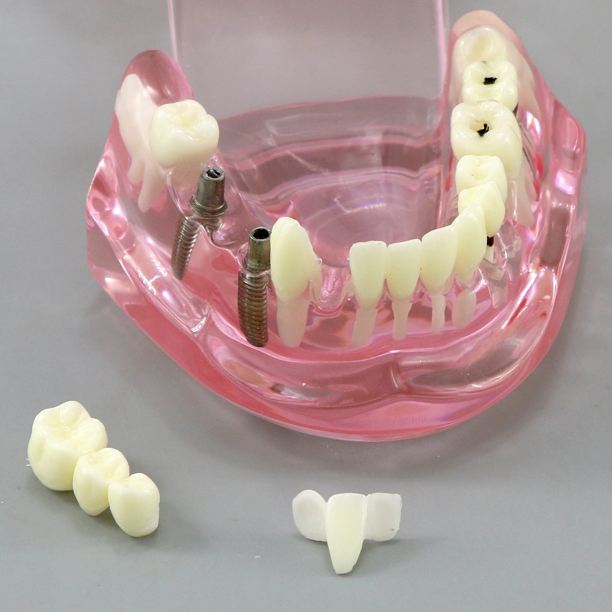 Dental Teeth Model Teaching Model Implant Disease Teeth Repair Restoration Bridge for Dentist Teaching Studying Demo M2001 Pink.