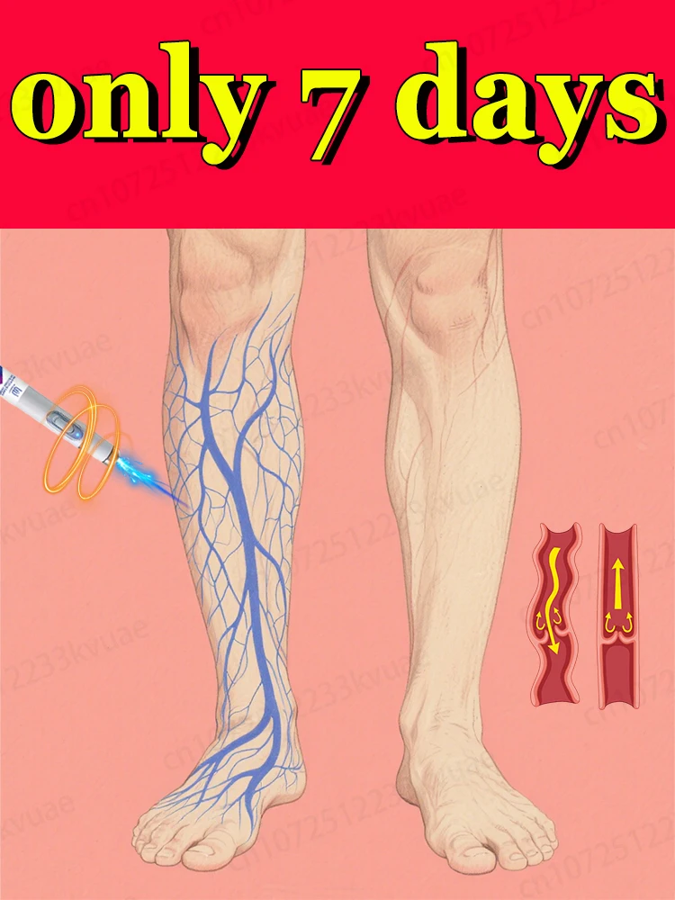 La génération-2 laser dit au revoir aux varices des jambes d'araignée en 7 jours