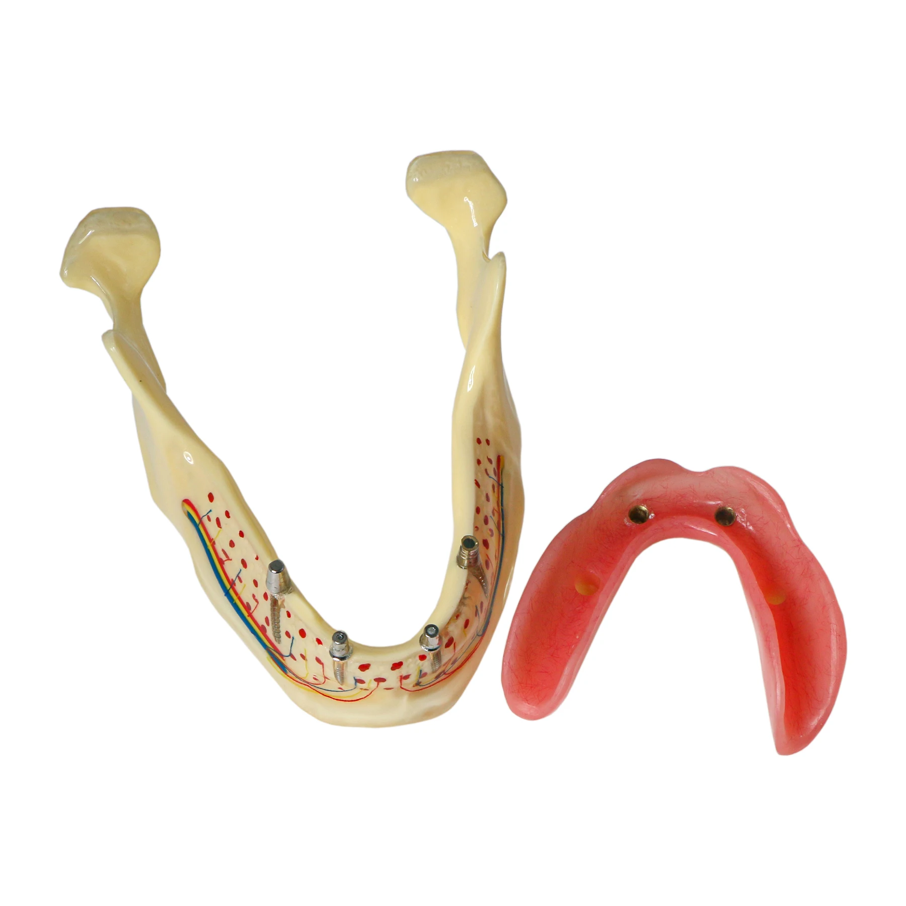 

Демонстрационная модель зубного имплантата Typodont со съемными зубами M6005