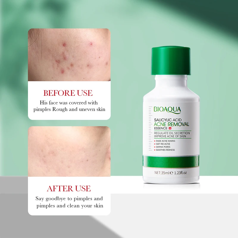 Salicylic Acid Acne Removing Essence Face Serum Shrink Pores Products Korean Facial Repairing Skincare Moisturizing Serum Q0G9 - Image 5